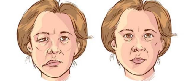 مرض العصب السابع - شلل الوجه النصفي